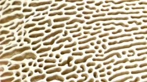 Candidiasis, Yeast & Fungal Overgrowth